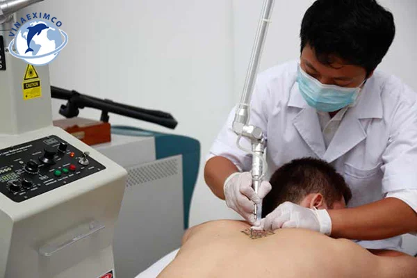 Xóa hình xăm để đi XKLĐ Đài Loan